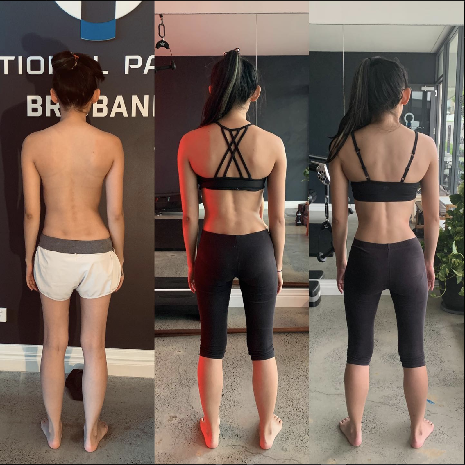 Scoliosis